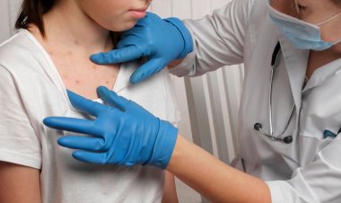 Viruela símica: cómo se contagia y por qué debemos estar en alerta