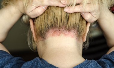 Psoriasis, una enfermedad crónica de la piel que impacta la calidad de vida y se ve perjudicada por el exceso de sol