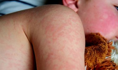 Escarlatina en la Región del Maule: autoridades sanitarias en alerta por aumento de casos