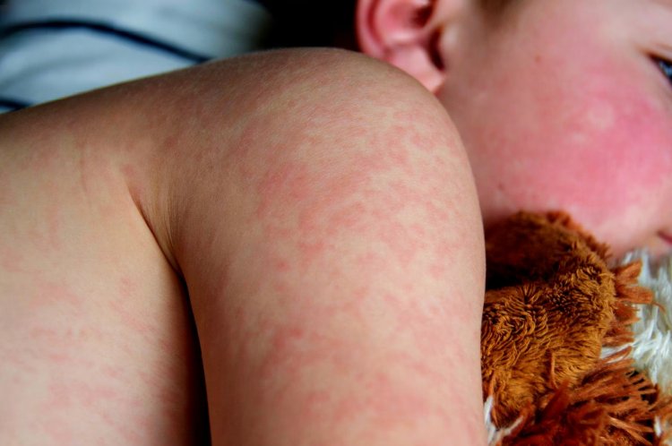 Escarlatina en la Región del Maule: autoridades sanitarias en alerta por aumento de casos