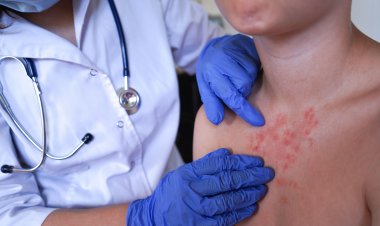 Escarlatina en el contexto escolar