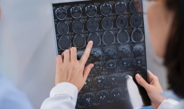 Enfermedades del cerebro: ¿cuáles son las más comunes en Chile?