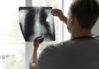 Enfermedad Pulmonar Obstructiva Crónica: cuáles son sus causas y riesgos