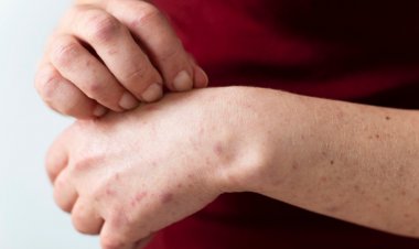 Alerta sanitaria por sarampión: ¿Quiénes deben vacunarse?