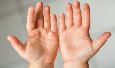 Enfermedad boca-mano-pie: qué hacer ante un contagio y cuáles son sus señales de alerta